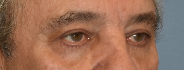 Eyelid Lift Before & After Gallery - Patient 157518 - Image 4