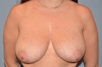 Breast Reduction Before & After Gallery - Patient 125759 - Image 1