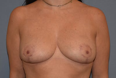 Breast Reduction Before & After Gallery - Patient 125759 - Image 2