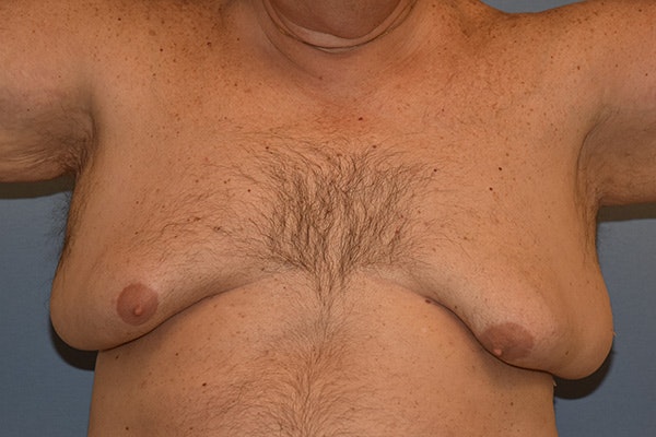Gynecomastia Before & After Gallery - Patient 110015 - Image 1