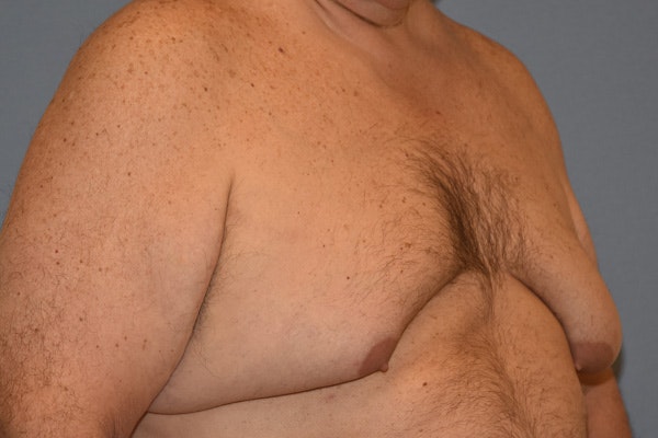 Gynecomastia Before & After Gallery - Patient 110015 - Image 3