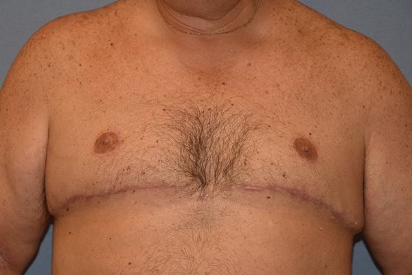 Gynecomastia Before & After Gallery - Patient 110015 - Image 2