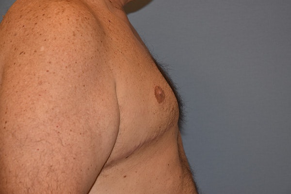 Gynecomastia Before & After Gallery - Patient 110015 - Image 6
