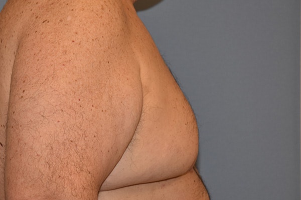 Gynecomastia Before & After Gallery - Patient 110015 - Image 5