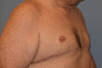 Gynecomastia Before & After Gallery - Patient 110015 - Image 4