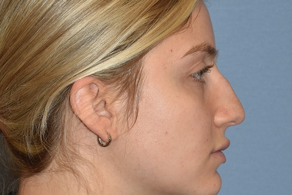 Rhinoplasty Before & After Gallery - Patient 675265 - Image 1