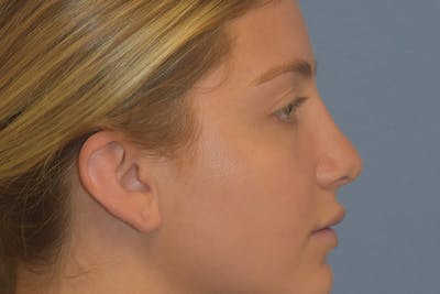 Rhinoplasty Before & After Gallery - Patient 675265 - Image 2