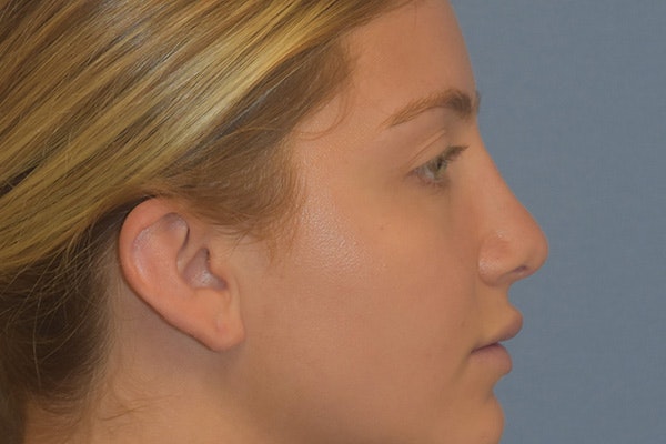 Rhinoplasty Before & After Gallery - Patient 675265 - Image 2