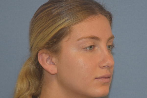 Rhinoplasty Before & After Gallery - Patient 675265 - Image 6
