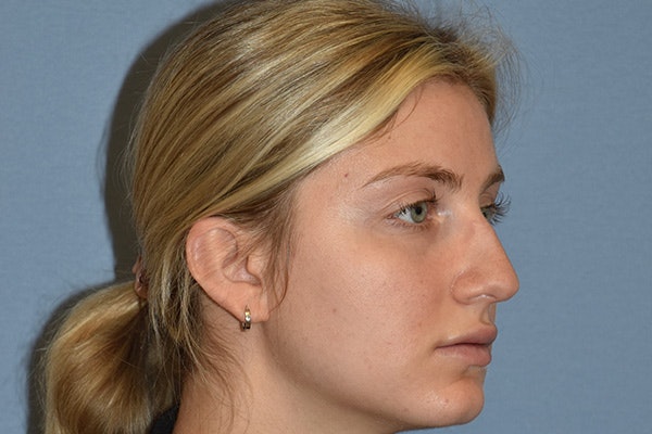 Rhinoplasty Before & After Gallery - Patient 675265 - Image 5