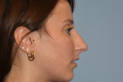 Rhinoplasty Before & After Gallery - Patient 375010 - Image 1