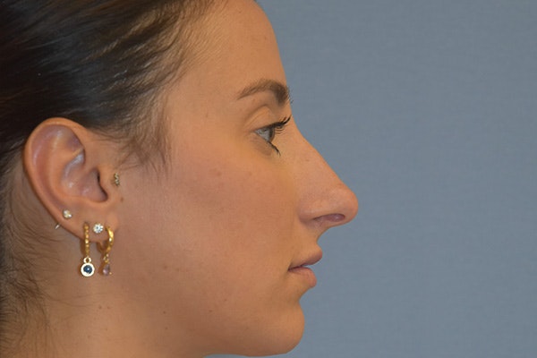 Rhinoplasty Before & After Gallery - Patient 375010 - Image 2