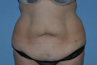 Tummy Tuck Before & After Gallery - Patient 176537 - Image 1