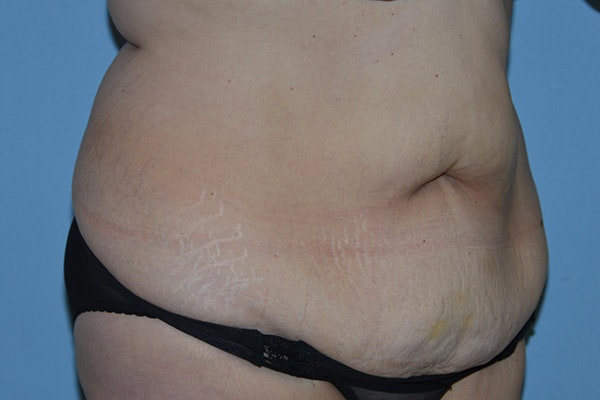 Tummy Tuck Before & After Gallery - Patient 176537 - Image 3