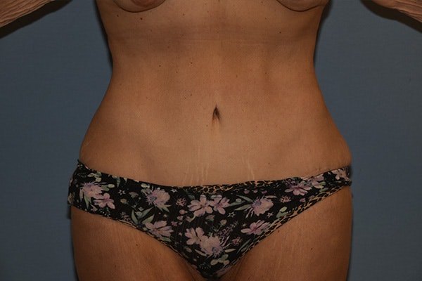Tummy Tuck Before & After Gallery - Patient 176537 - Image 2