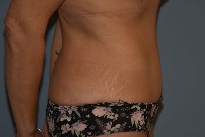 Tummy Tuck Before & After Gallery - Patient 176537 - Image 6