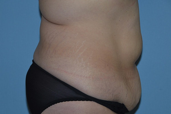 Tummy Tuck Before & After Gallery - Patient 176537 - Image 5