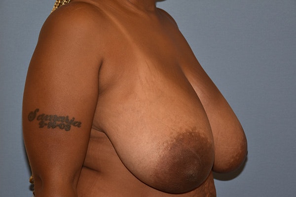Breast Reduction Before & After Gallery - Patient 292274 - Image 3