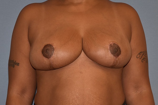 Breast Reduction Before & After Gallery - Patient 292274 - Image 2
