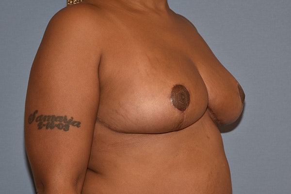 Breast Reduction Before & After Gallery - Patient 292274 - Image 4