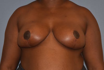 Breast Reduction Before & After Gallery - Patient 366603 - Image 2