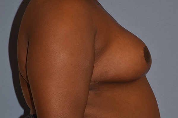 Breast Reduction Before & After Gallery - Patient 366603 - Image 6