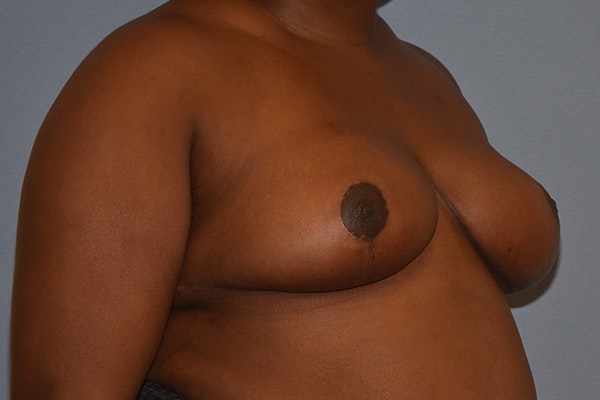 Breast Reduction Before & After Gallery - Patient 366603 - Image 4
