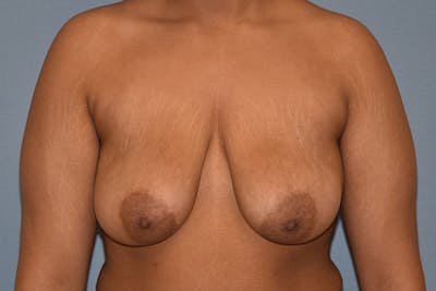 Breast Reduction Before & After Gallery - Patient 217547 - Image 1