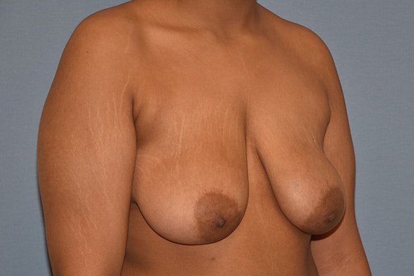 Breast Reduction Before & After Gallery - Patient 217547 - Image 3