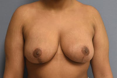 Breast Reduction Before & After Gallery - Patient 217547 - Image 2
