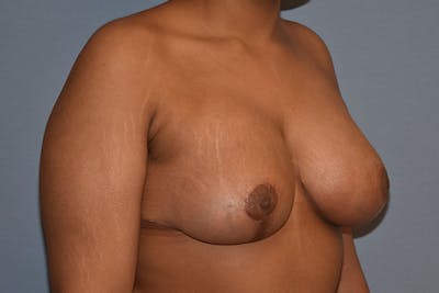 Breast Reduction Before & After Gallery - Patient 217547 - Image 4