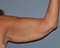 Arm Lift Before & After Gallery - Patient 238452 - Image 1