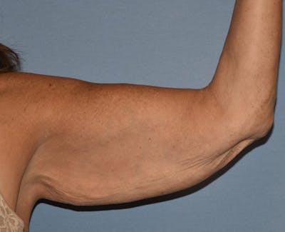 Arm Lift Before & After Gallery - Patient 238452 - Image 1