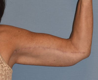 Arm Lift Before & After Gallery - Patient 238452 - Image 2