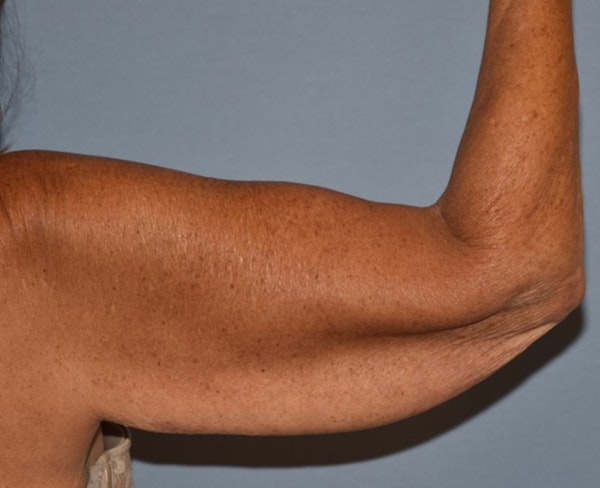 Arm Lift Before & After Gallery - Patient 238452 - Image 3