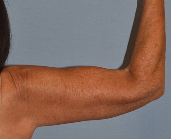 Arm Lift Before & After Gallery - Patient 238452 - Image 4