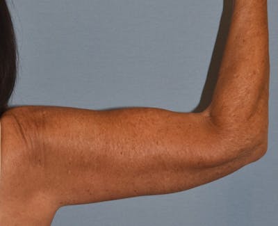 Arm Lift Before & After Gallery - Patient 238452 - Image 4