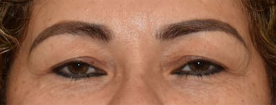 Eyelid Lift Before & After Gallery - Patient 349272 - Image 1