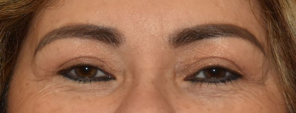 Eyelid Lift Before & After Gallery - Patient 349272 - Image 2