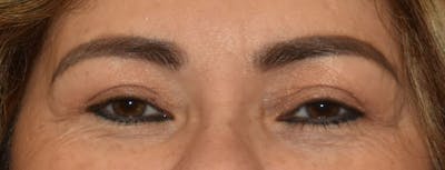 Eyelid Lift Before & After Gallery - Patient 349272 - Image 2