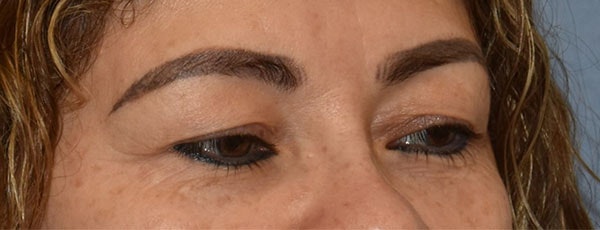 Eyelid Lift Before & After Gallery - Patient 349272 - Image 3
