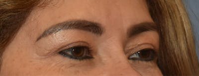 Eyelid Lift Before & After Gallery - Patient 349272 - Image 4
