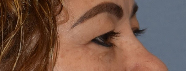 Eyelid Lift Before & After Gallery - Patient 349272 - Image 5