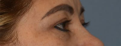 Eyelid Lift Before & After Gallery - Patient 349272 - Image 6