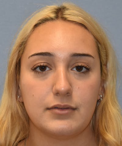 Rhinoplasty Before & After Gallery - Patient 143771436 - Image 1