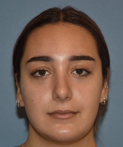 Rhinoplasty Before & After Gallery - Patient 143771436 - Image 2
