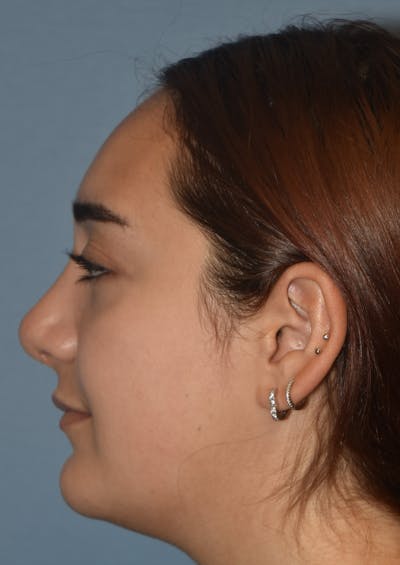 Rhinoplasty Before & After Gallery - Patient 143771436 - Image 4