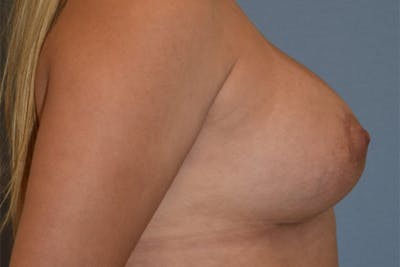 Breast Asymmetry Before & After Gallery - Patient 122327 - Image 6