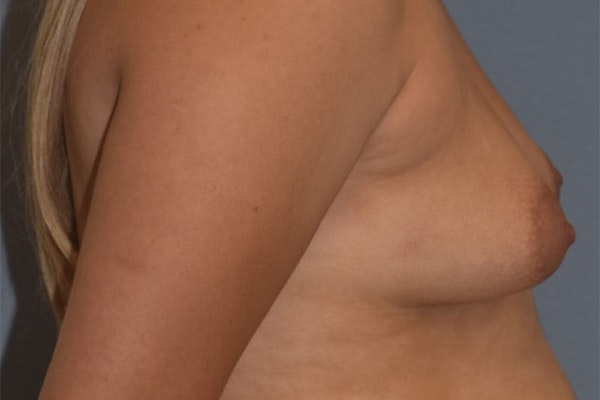 Breast Asymmetry Before & After Gallery - Patient 122327 - Image 5