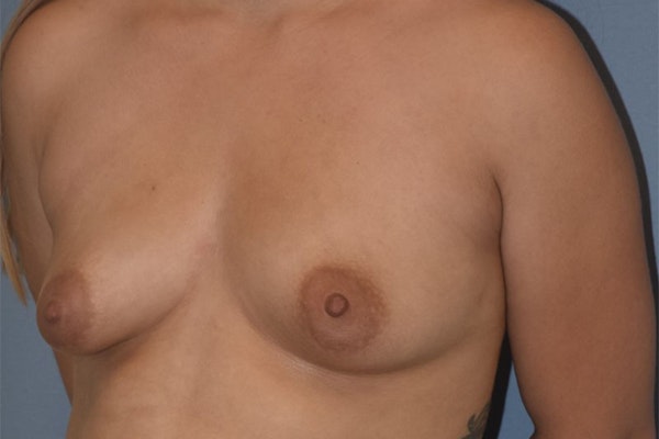 Breast Asymmetry Before & After Gallery - Patient 122327 - Image 3